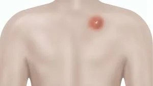 Abscess