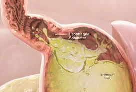 Acid Reflux