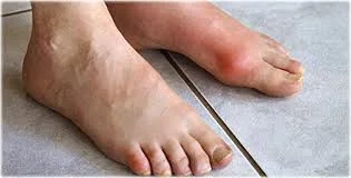 Gout